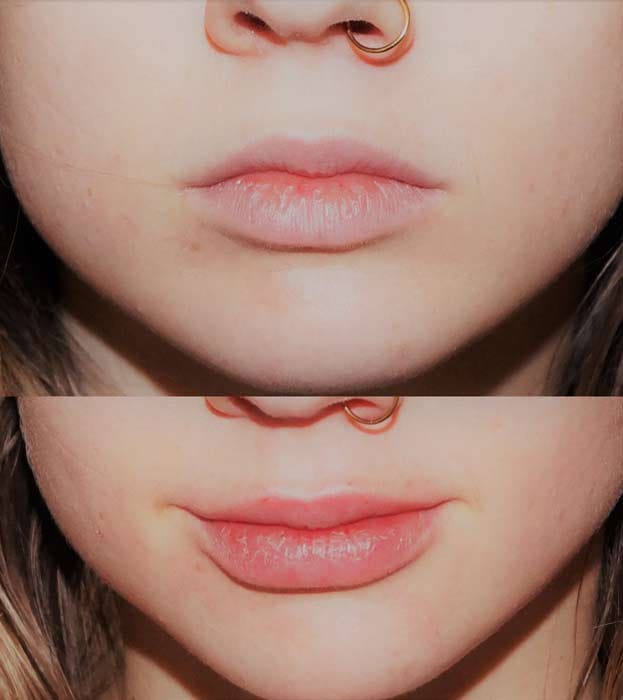powiększanie ust kwasem hialuronowym